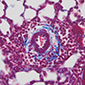 pulmonary hypertension